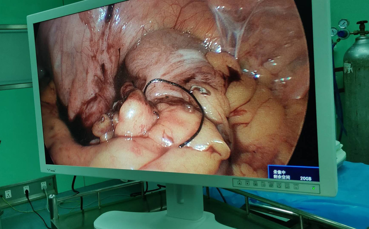 【益柯達(dá)】4K超高清內(nèi)窺鏡攝像系統(tǒng)首次臨床 【益柯達(dá)】4K超高清內(nèi)窺鏡攝像系統(tǒng)首次臨床