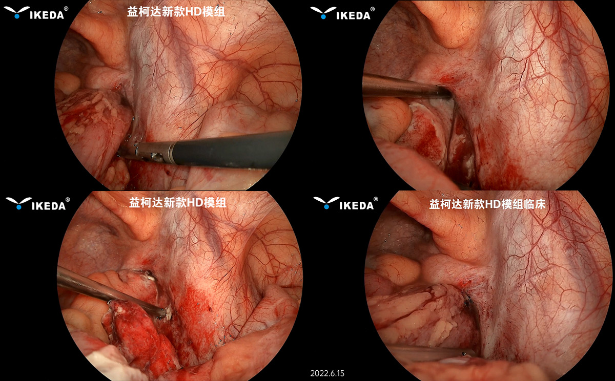益柯達(dá)-新款HD內(nèi)窺鏡模組首次臨床 益柯達(dá)-新款HD內(nèi)窺鏡模組首次臨床